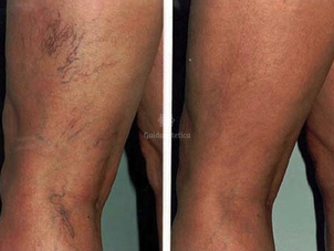 Terapia capillari