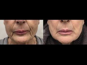 Trattamenti per ringiovanire