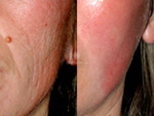 Laser cos resurfacing