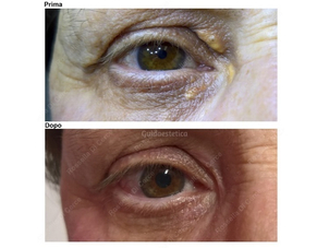 Xantelasmi regressione