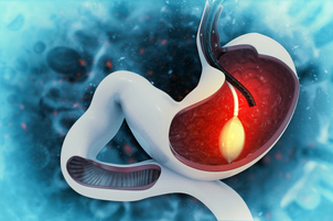 Palloncino intragastrico BIB