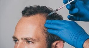 infiltrazioni contro alopecia