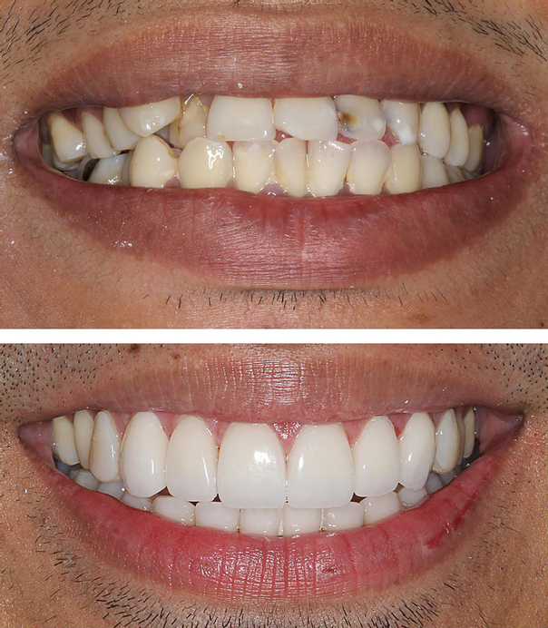 Before & After trattamento ortodonzia invisibile