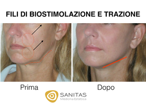 Prima e dopo fili riassorbibili