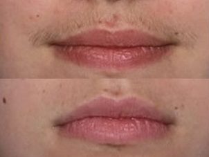 Epilazione del labbro superiore