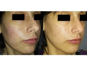 Volto di ragazza con rosacea