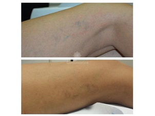 Capillari gambe