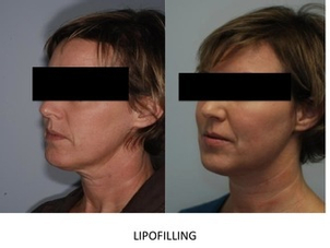 Trapianto di grasso autologo