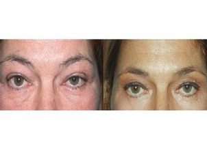 Risultato chirurgia palpebre cadenti