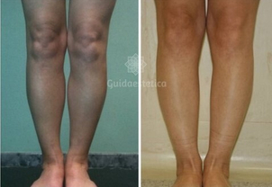 Aumento polpacci risultato e postoperatorio