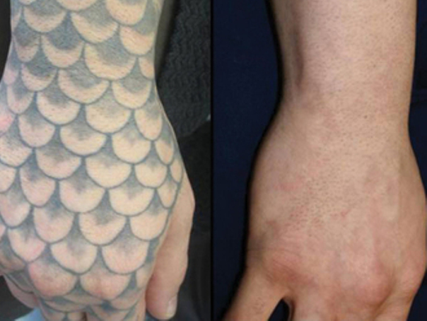 Rimozione tatuaggio dalla mano