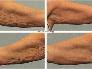 Radiofrequenza braccia