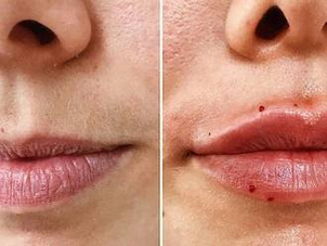 Acido ialuronico effetti