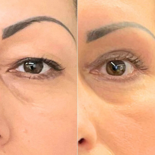 Risultati e postoperatorio chirurgia palpebre