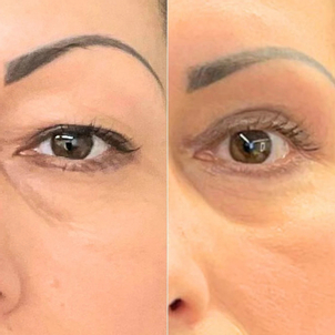 Risultati e postoperatorio chirurgia palpebre