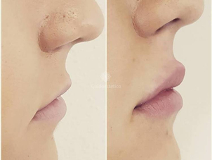 Aumento labbra risultati