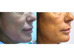 Esempio di trattamento cutaneo laser