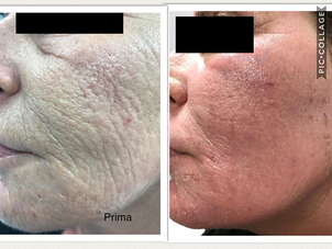 Peeling chimico pori dilatati