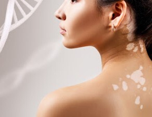 Da cosa è causata la vitiligine?