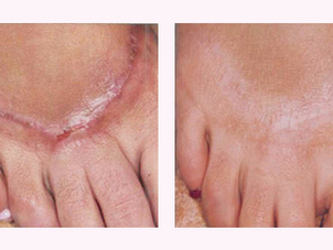 Trattamento cicatrice sul piede