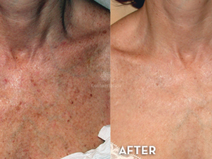 Benefici del needling sul delcolletee