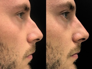 Rinoplastica non chirurgica maschile