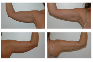 Risultati liposuzione braccia