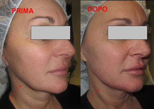 Prima e dopo intervento di genioplastica