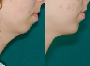 Correzione mento sfuggente