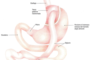 Intervento stomaco per dimagrire