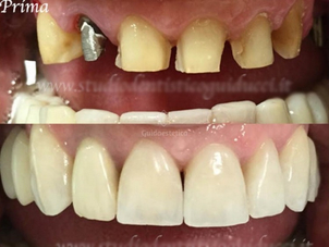 Implantologia risultati