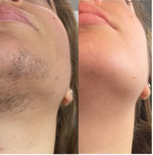 Epilazione mascile della barba