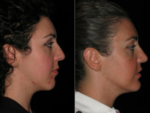 Asimmetria facciale corretta con intervento maxillo facciale