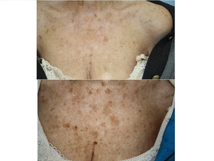 Risultati trattamento macchie della pelle