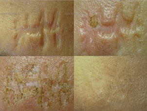 Rischi post operatori del trattamento delle cicatrici