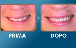 Risultati apparecchio ai denti