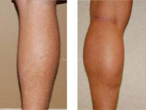 Protesi polpacci prima e dopo