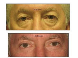 Risultato blefaroplastica palpebre