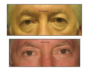 Risultato blefaroplastica palpebre