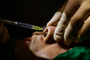 Rinoplastica non chirurgica