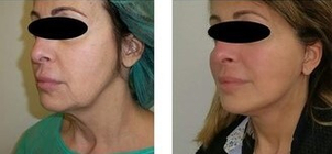 Risultato post mini lifting