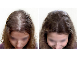 Risultato autotrapianto capelli