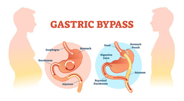 bypass gastrico