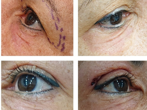 fasi blefaroplastica