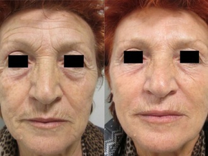 Filler acido ialuronico prima e dopo