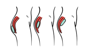 Come inserire protesi nei glutei