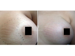 Prima e dopo cura Smagliature