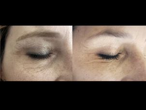 Blefaroplastica plexr prima e dopo