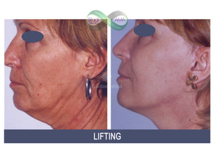Prima e dopo lifting del volto