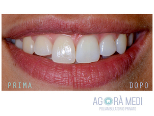 Risultati di un trattamento sbiancante dei denti